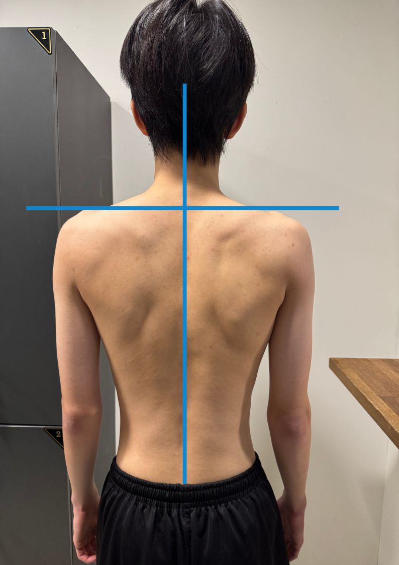 체형교정 PT 운동 후 어깨 높이 비교